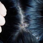 fungal-problems-on-the-head-dry-hair-and-itching-from-dandruff.jpg